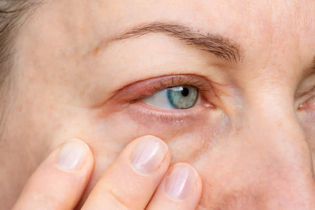 Opuchnięte oczy od alergii? Szybka ulga i domowe sposoby