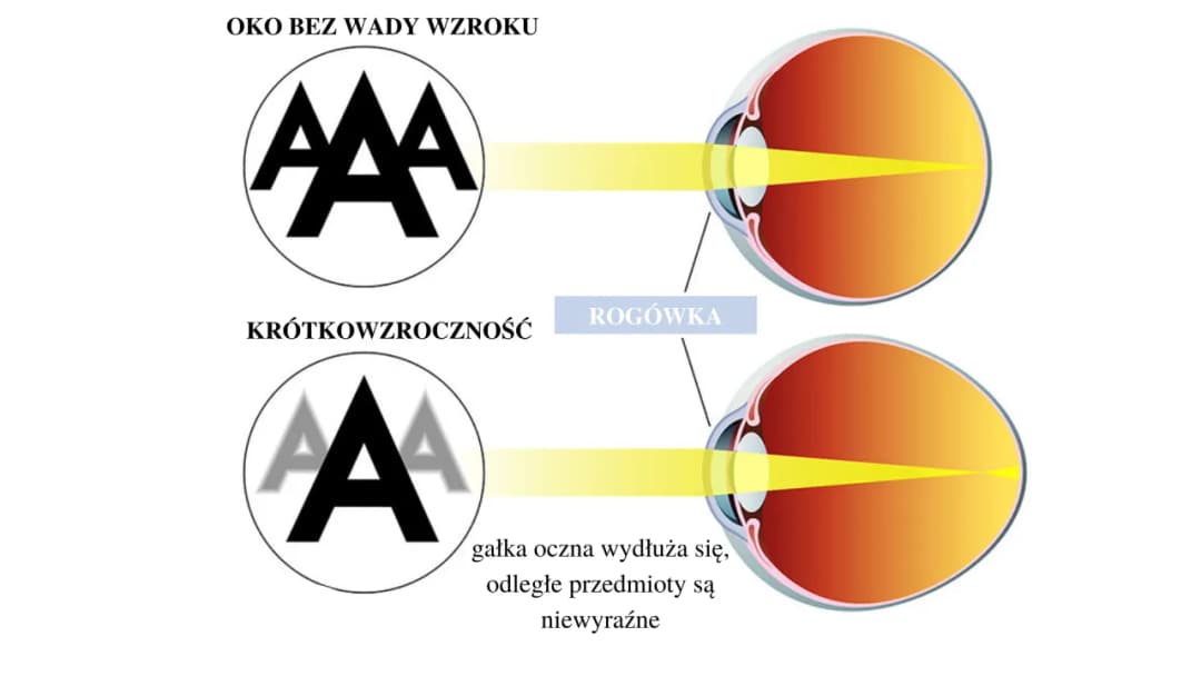 Czy głowa może boleć od wady wzroku? Sprawdź, co musisz wiedzieć